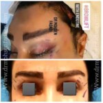تراش استخوان ابرو و لیفت ابرو با اندوتاین