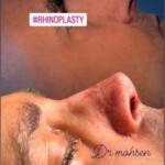 جراحی بینی