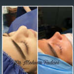 جراحی بینی | دکتر فدایی