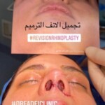 جراحی ترمیمی بینی