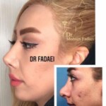 جراحی ترمیمی بینی