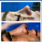 جراحی ترمیمی بینی